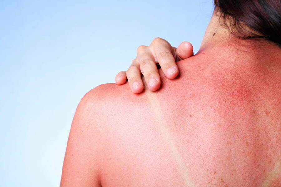 Chỉ số UV từ 8 - 10 đang tăng cao, nguy cơ bị tổn hại da nếu tiếp xúc trực tiếp với ánh nắng  trong vòng 25 phút da sẽ bị bỏng