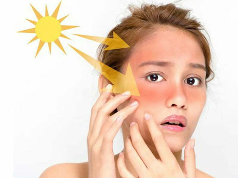 Tia UV có xuyên qua kính không? 3 Da bị cháy nắng là do tiếp cận quá nhiều tia UV