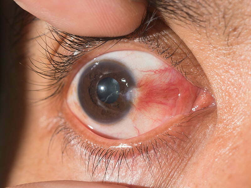 Nguyên nhân chính dẫn tới bệnh mộng mắt, kết mạc là từ tia UV