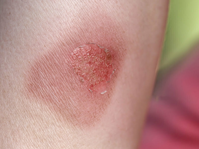 Tia UV làm cho da bị bỏng là hiện hiện tượng rất phổ biến